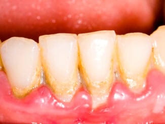 Potraviny, které přirozenou cestou bojují se zubním plakem
