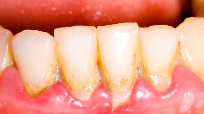 Potraviny, které přirozenou cestou bojují se zubním plakem
