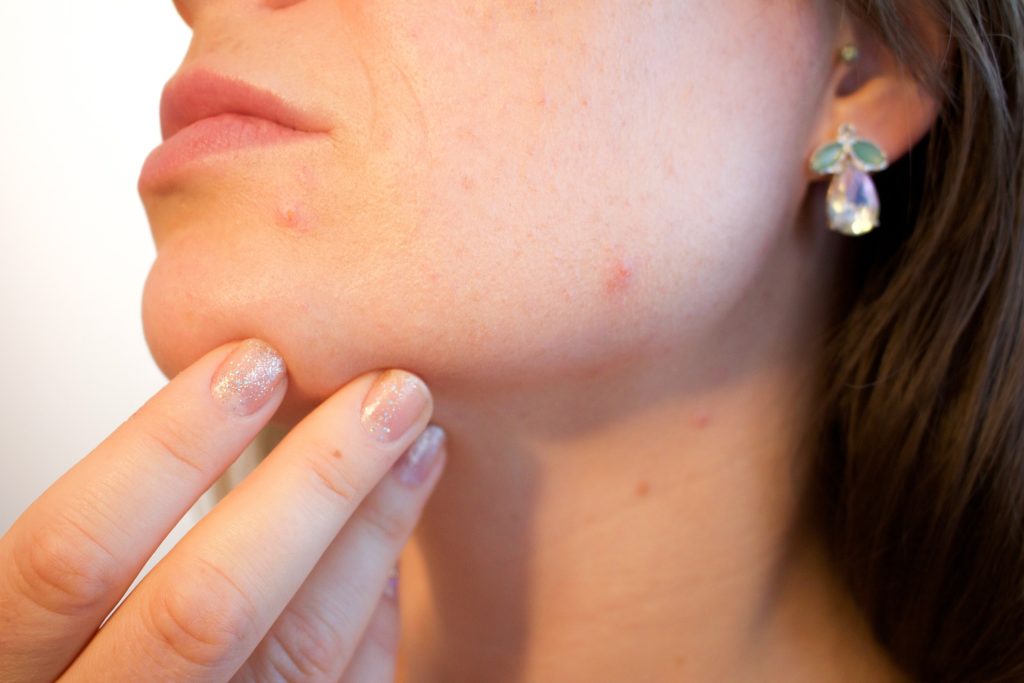 Jak se zbavit akné: 9 tipů, které fungují
