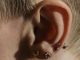 Propíchnutí uší může vést ke ztrátě kilogramů. Jde ale o velmi nebezpečný způsob hubnutí